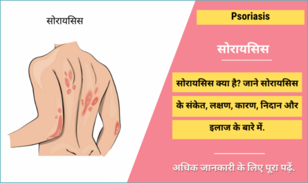 Psoriasis in Hindi