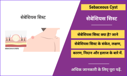 Sebaceous Cyst in Hindi