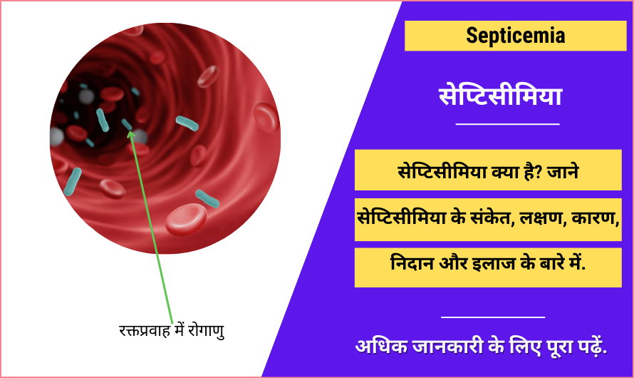 सेप्टिसीमिया – Septicemia in Hindi