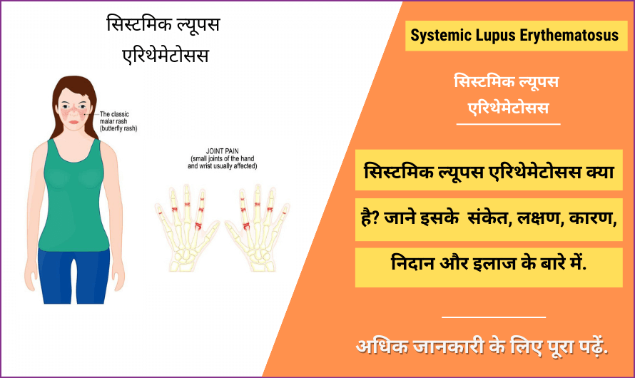 सिस्टमिक ल्यूपस एरिथेमेटोसस – Systemic Lupus Erythematosus in Hindi