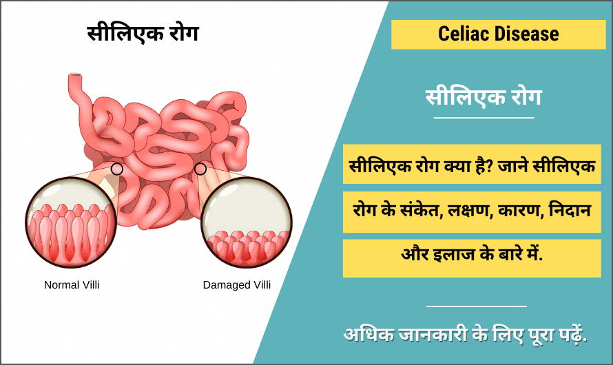 सीलिएक रोग – Celiac Disease in Hindi