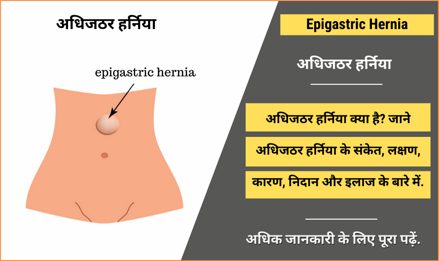 अधिजठर हर्निया – Epigastric Hernia in Hindi