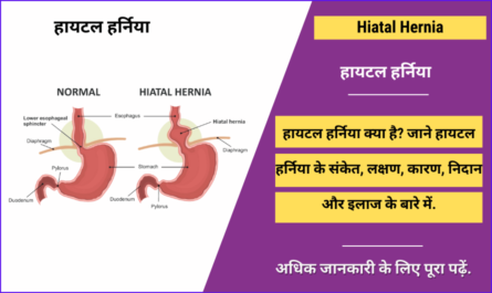 Hiatal Hernia in Hindi