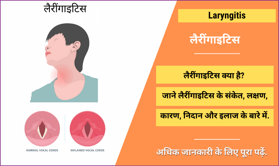 लैरींगाइटिस – Laryngitis in Hindi