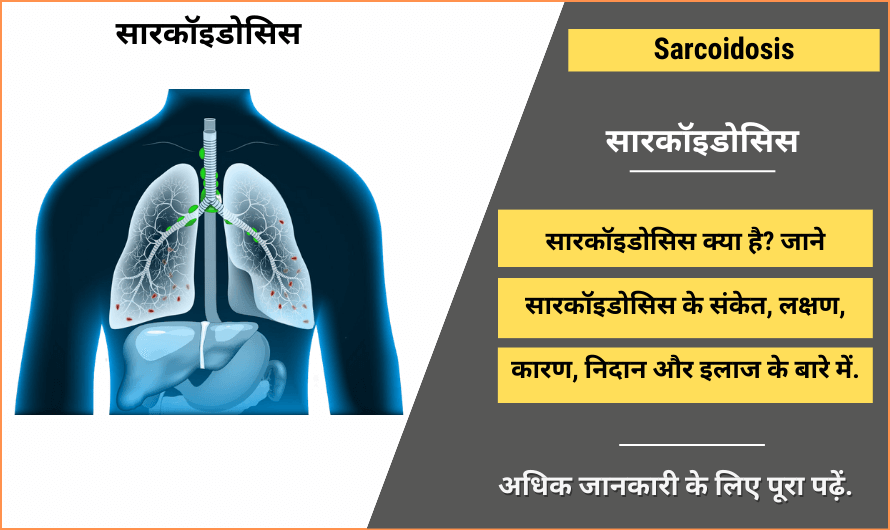 सारकॉइडोसिस – Sarcoidosis in Hindi