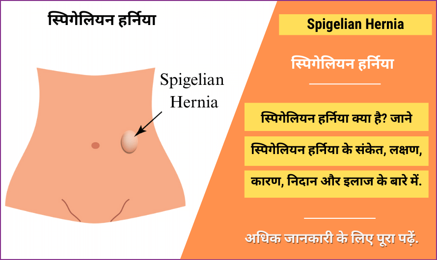 स्पिगेलियन हर्निया – Spigelian Hernia in Hindi