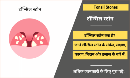 Tonsil Stones in Hindi