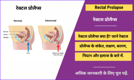 Rectal Prolapse in Hindi